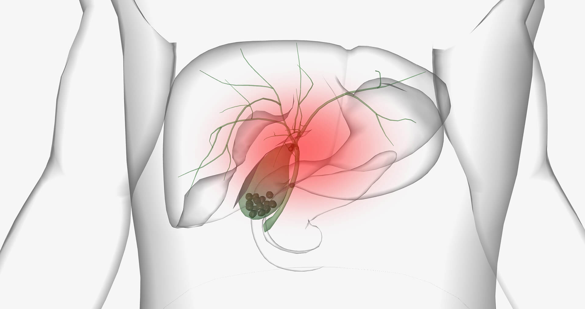 GI-Gallstones-What-Are-They-&-What-Causes-Them